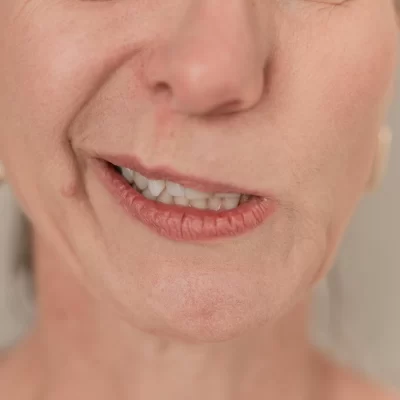 Paralisia Facial